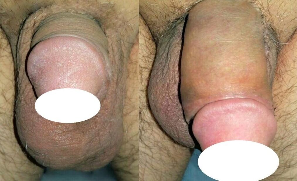 foto's voor en na penisvergroting
